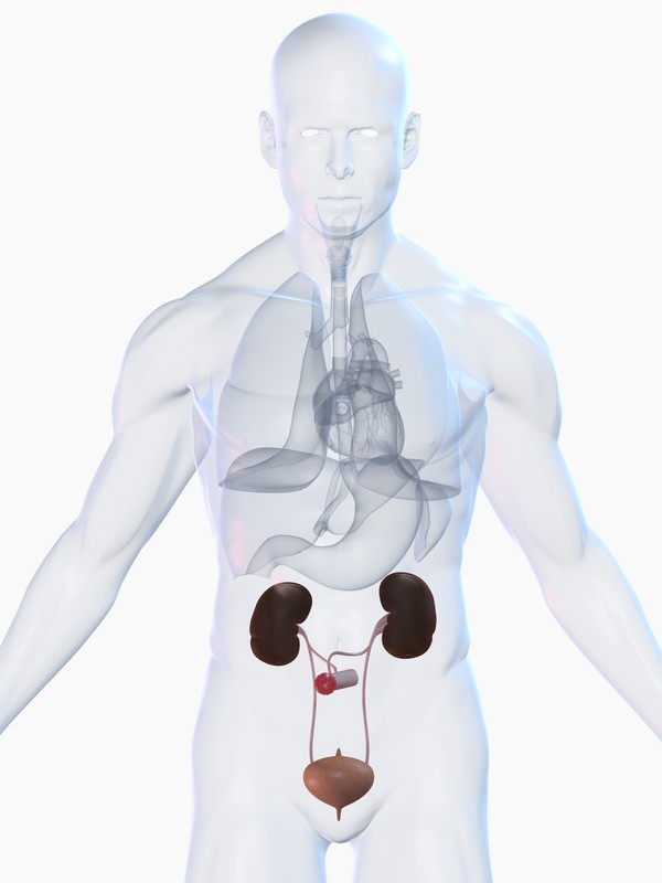 Urostomie ou stomie urinaire : un acte chirurgical, définitif ou temporaire, qui permet de déconnecter vos uretères de votre vessie afin d’assurer la fonction rénale.