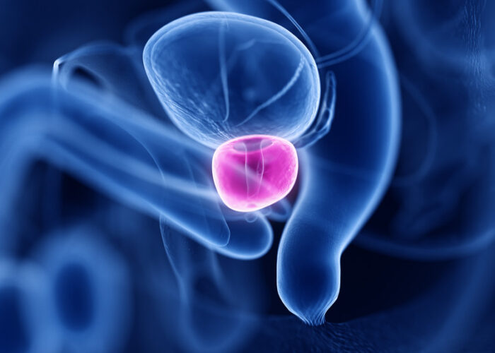 Plus de 110 millions d’hommes dans le monde seraient concernés par une hypertrophie bénigne de la prostate de la prostate.